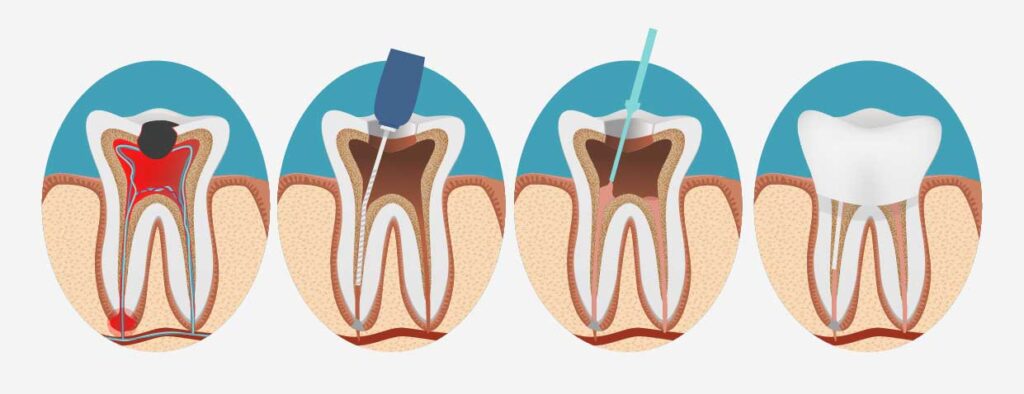 wurzelkanalbehandlung