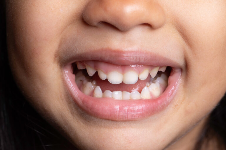 Kindergesicht, Kinderzähne, frühkindliche Behandlung beim Kieferorthopäden
