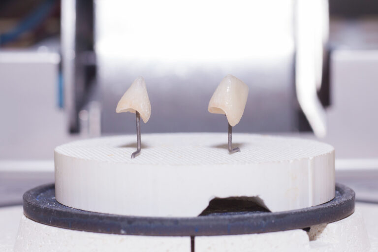 Zahnkronen im CEREC- Verfahren hergestellt